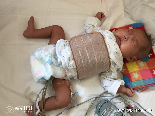 同胎不同命，妹妹仨月开两刀，与姐姐再见时已不像双胞胎