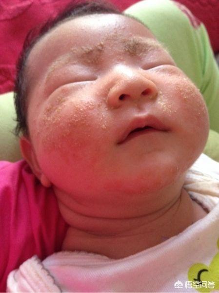 婴儿湿疹很严重，额头上和脸上都有，该怎么办？