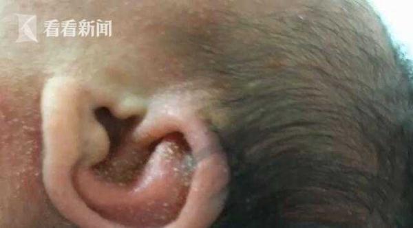 宝宝出身一天全身长满“脓包” 罪魁祸首竟是它