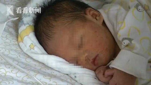 宝宝出身一天全身长满“脓包” 罪魁祸首竟是它