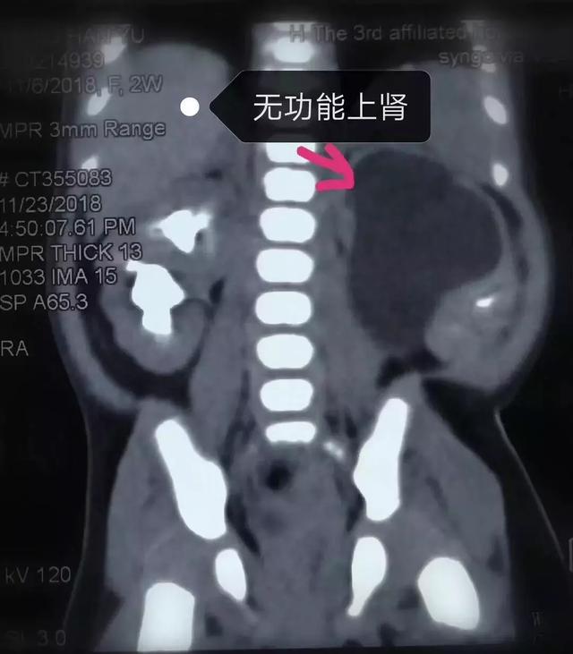 出生12天的宝宝重复肾畸形！医生腹腔镜下切除，出血仅5ml！