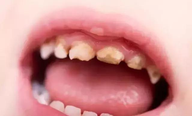 1 岁后不戒奶瓶竟有这么多危害？宝宝就是戒不掉怎么办？