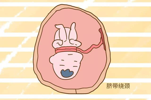 孕妈别慌，胎儿发生脐带绕颈后这样处理！
