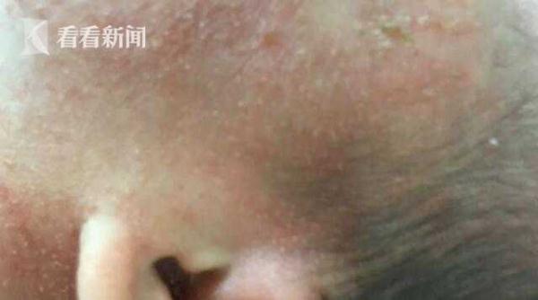宝宝出身一天全身长满“脓包” 罪魁祸首竟是它