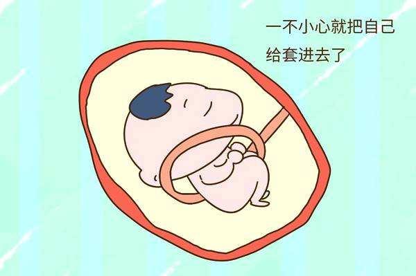 怀孕6个月脐带绕颈胎儿引产，脐带绕颈真有这么危险吗？