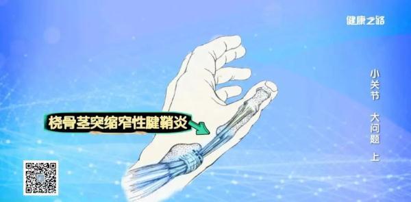 三个错误习惯导致了你患上腱鞘炎，快来纠正一下