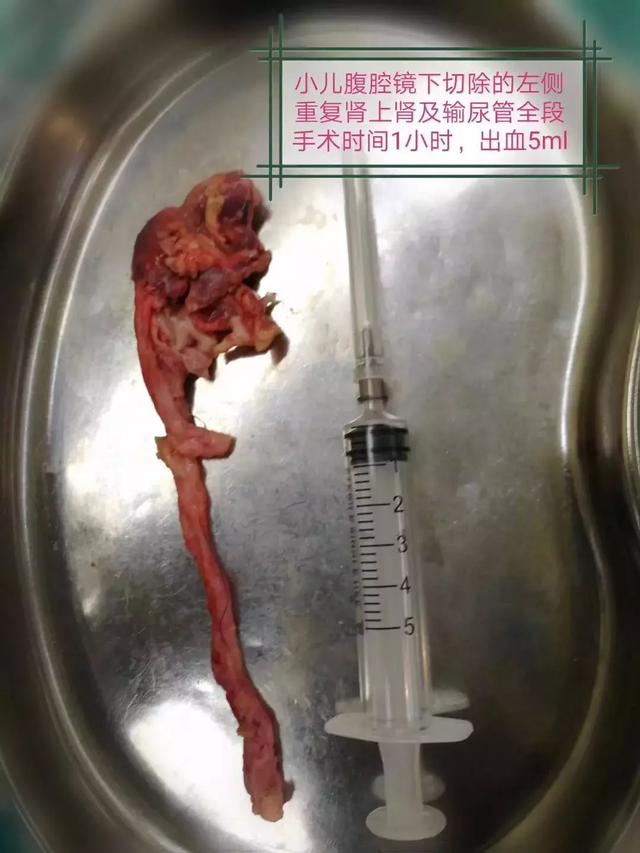 出生12天的宝宝重复肾畸形！医生腹腔镜下切除，出血仅5ml！