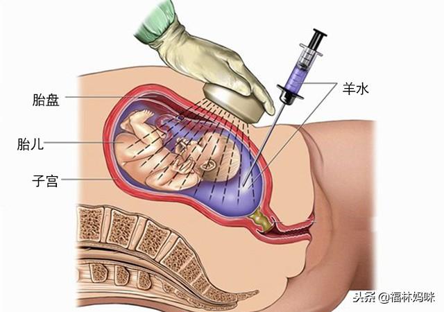 羊水穿刺到底做不做？这5种情况下，为了宝宝健康孕妈勇敢一次吧