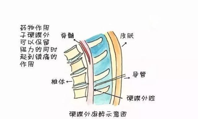 镇痛分娩了解一下？