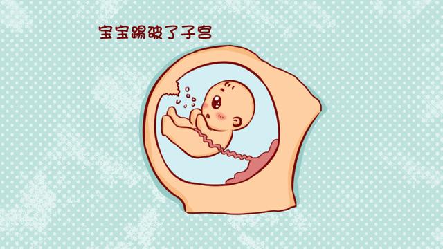 胎儿竟然踢破子宫？原来是瘢痕子宫惹得祸！