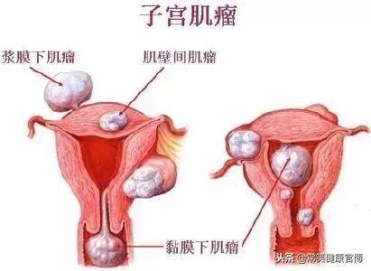 女白领终于怀上孩子却发现子宫有肌瘤，孕期子宫肌瘤影响宝宝吗？