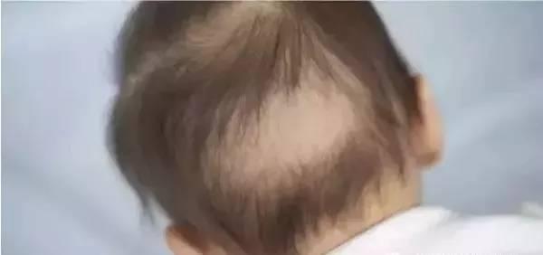 宝宝枕秃、头发稀疏到底要不要补钙？警惕这两种秃头症更重要！