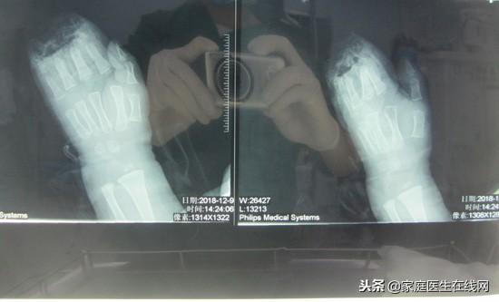 1岁半男童被切断4指，医生奋战7.5小时，方才保住了手指