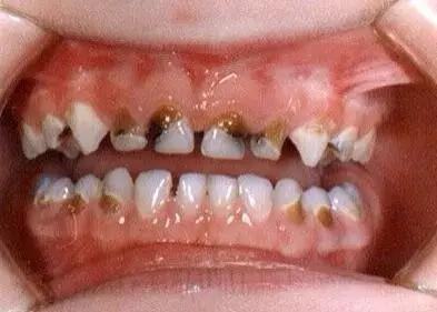 宝宝门牙发黄发黑，还总是牙疼，医生：早干什么了