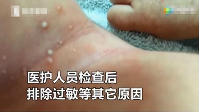 新生儿出生第一天身上就起满脓包，罪魁祸首是家长这样的做法