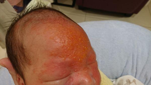 严重的面部脂溢性皮炎！照顾婴儿的经验分享！