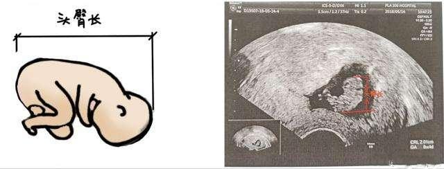 怀孕13周的B超检查，哪些指标显示宝宝的健康问题？注意这4个指标