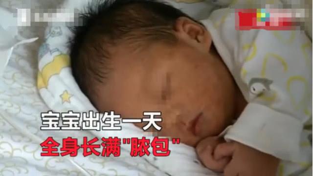 新生儿出生第一天身上就起满脓包，罪魁祸首是家长这样的做法