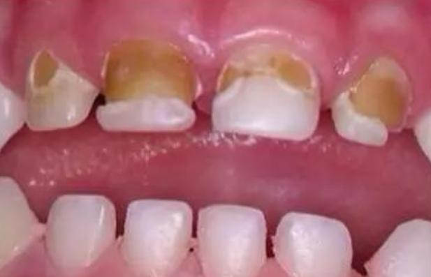 宝宝门牙发黄发黑，还总是牙疼，医生：早干什么了