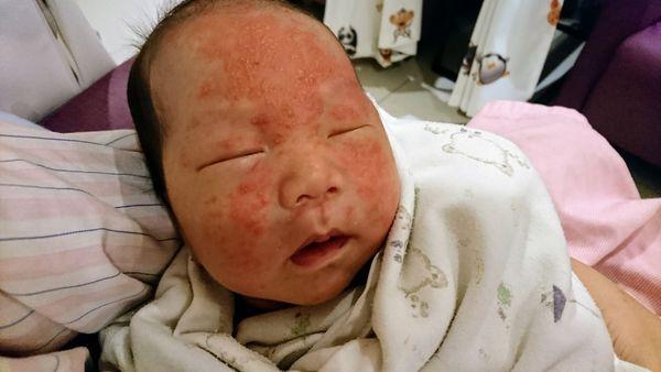 严重的面部脂溢性皮炎！照顾婴儿的经验分享！