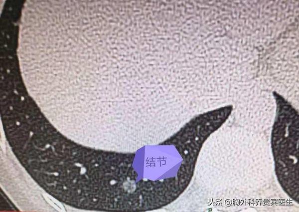 27岁年轻妈妈诊断出肺腺癌，却不敢让家人知道