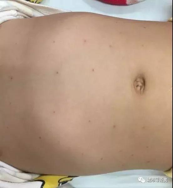 「离谱」2岁女童高烧多日不退，身上被发现有几十个针眼儿