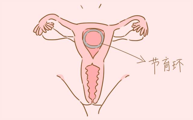 女性碰上这几种情况，要及时取出节育环，不然老了很受罪