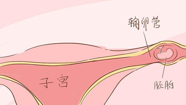 孕早期出现这4种症状，可能是宫外孕，中了的孕妈要当心