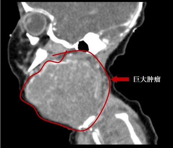 刚出生的婴儿头颈上还挂着一个“脑袋”大的肿瘤