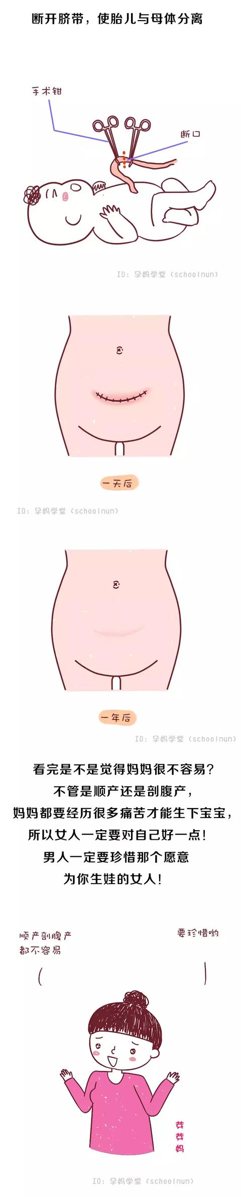 直击剖腹产全过程，感动！