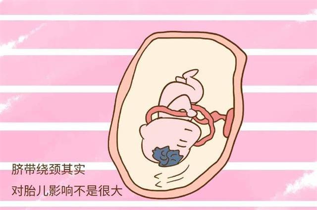 孕产说：怎么判断胎儿是否绕颈？听妇产科医生来给你说说