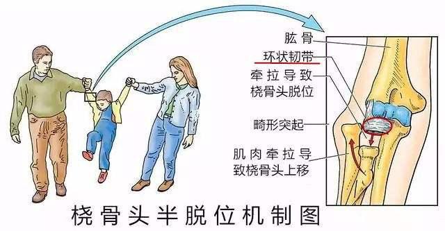 宝宝被大人牵拉后肘部疼痛、哭闹、无法活动！当心这里出了问题！