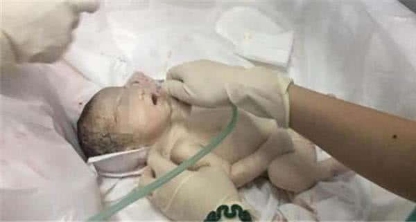 超预产期4周宝宝还没动静，安全起见剖腹产，生出宝宝后妈妈疼哭