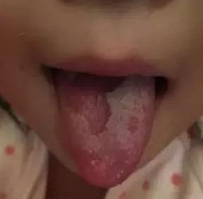 这6种舌苔直接反映出孩子的健康，妈妈遇到都想收藏