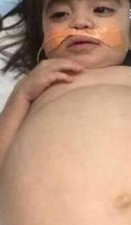 美国2岁宝宝患病肚胀如球，靠爸爸捐肾幸运治愈