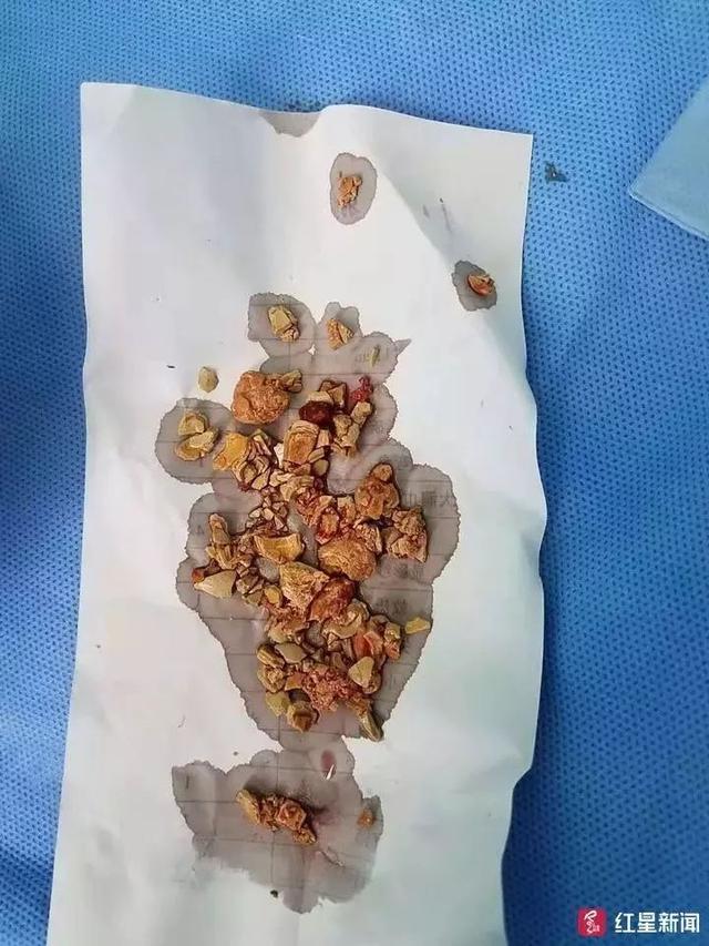 5个月大女婴双肾长满结石！养孩子，千万别这样做