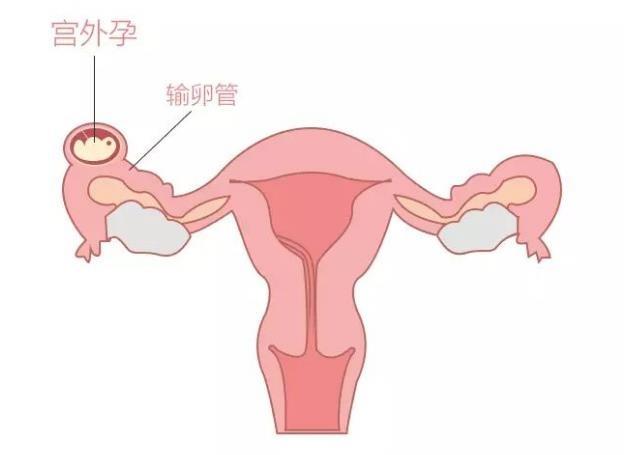 关于宫外孕，这3个原因女人应该知道，作为男人更要反省！