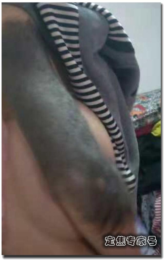 男孩一出生整条胳膊长“熊皮”，为防癌变整张换皮