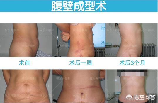 产后肚子赘肉下去了，肌肉还是松弛的，为什么？