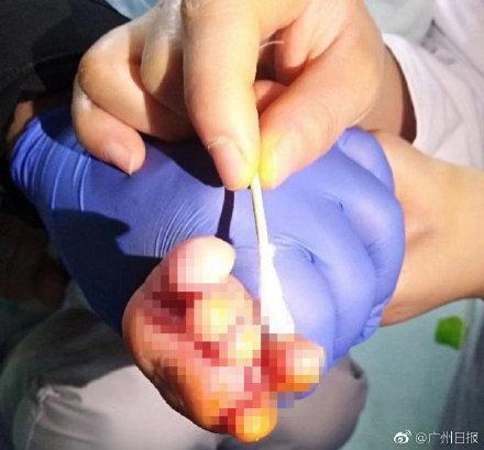 脚趾被袜子线头缠绕坏死，4 个月大的女婴或遭截趾