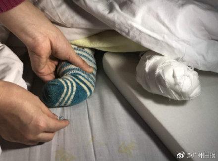 脚趾被袜子线头缠绕坏死，4 个月大的女婴或遭截趾