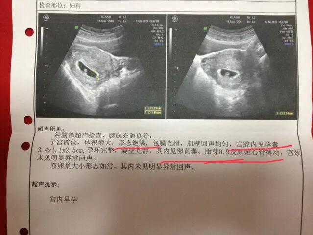 胎儿是否健康？手把手教你轻松学会看B超单