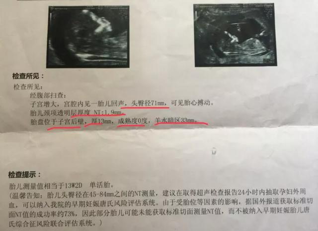 胎儿是否健康？手把手教你轻松学会看B超单