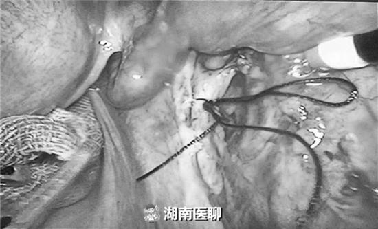 女子想要二孩却被迫终止妊娠，剖宫产瘢痕妊娠为什么这么可怕？