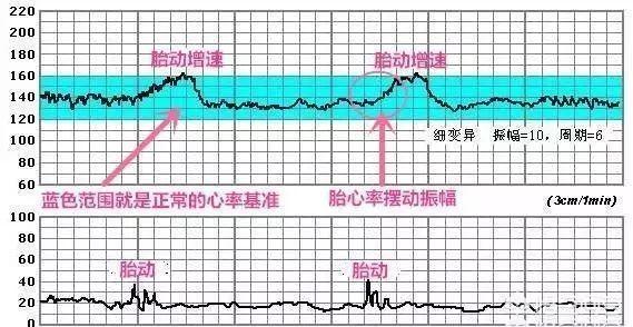 胎心监护的曲线有波动是好事吗？胎儿监护需要有波动吗？