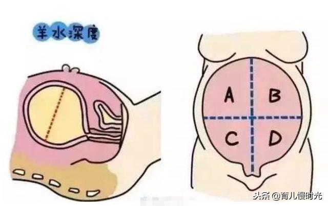 辟谣：孕晚期羊水过少喝豆浆，羊水过多吃西瓜？没啥用！