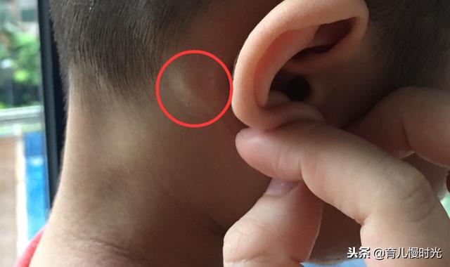 宝宝头上有个软疙瘩？会不会是长瘤了？