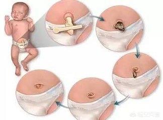 婴儿肚脐自然掉后是否要擦碘伏？