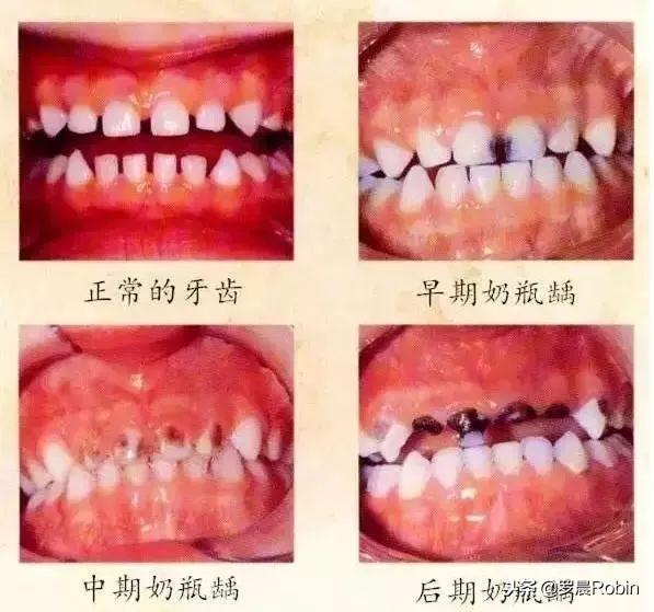 害人不浅的奶瓶龋！蛀牙的腐蚀速度超乎想象，牙齿“千疮百孔”！