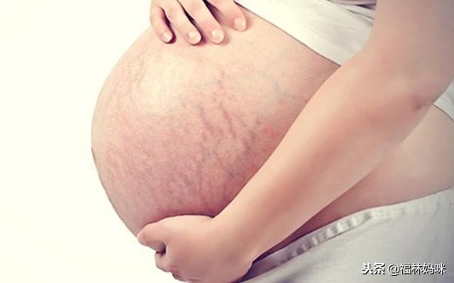 妊娠纹是妈妈的勋章？想远离妊娠纹，孕期要做到“内控外养”！